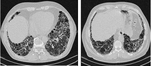 Fibrosis Pulmonar Idiopática (tomado de wikimedia commons)